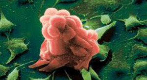 раковая клетка под микроскопом