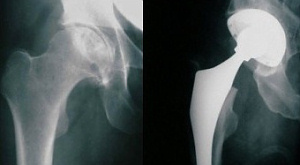 тазабедренный сустав и его протез на рентгенограмме